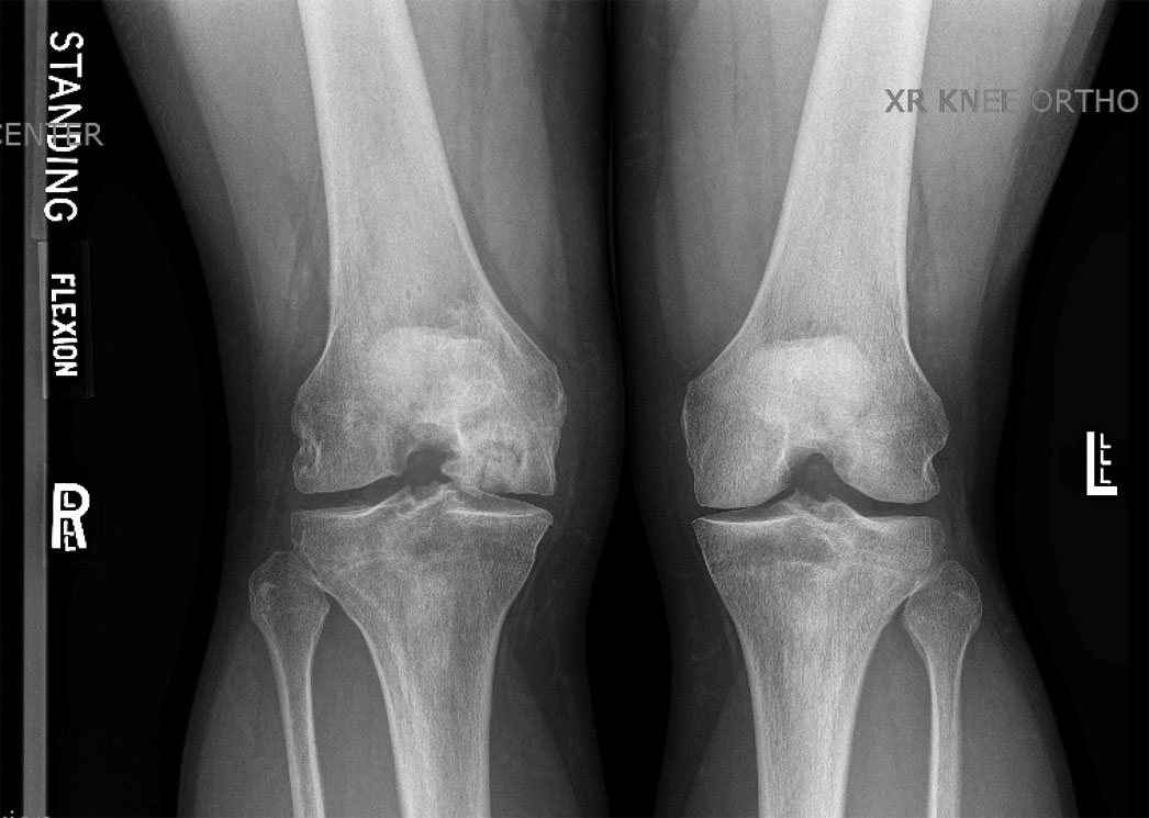 X-ray image of patient’s Medical OCD Lesion and continued bone irregularity